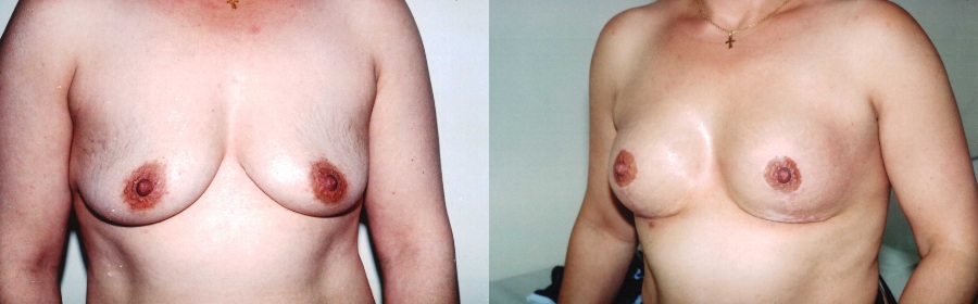 photos avant et après lipofilling seins tunisie