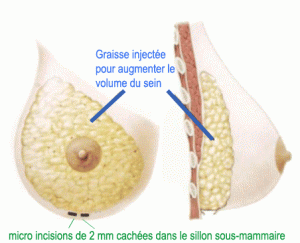 intervention lipofilling mammaire tunisie
