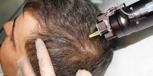 Mesotherapie cheveux-tunisie