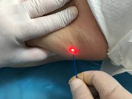 liposuccion laser-Tunisie