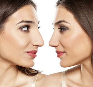 rhinoplastie-medicale-Tunisie