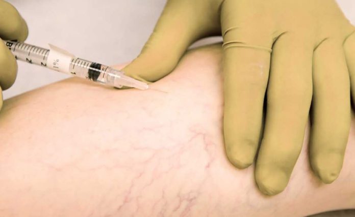 traitement-varices-tunisie